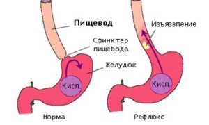 Как вылечить рефлюкс эзофагит навсегда: советы и рекомендации