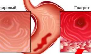 Можно ли шоколад при гастрите: советы и рекомендации