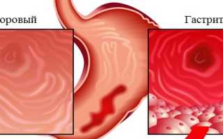 Можно ли шоколад при гастрите: советы и рекомендации