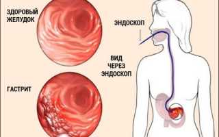 Рис в питании при гастрите: полезные свойства и рекомендации