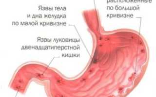 Рвота при язвенной болезни желудка: причины и лечение
