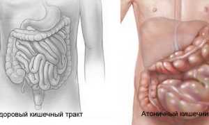 Запор атонический: причины и лечение