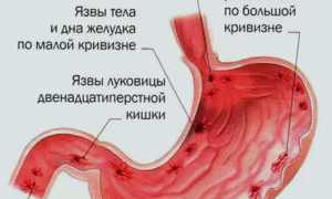 Симптомы язвы желудка: что нужно знать