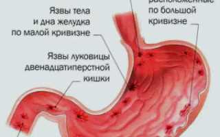 Симптомы язвы желудка: что нужно знать