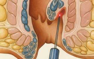 Лед в лечении геморроя: эффективные методы и советы