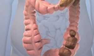 Запор хронический: причины и лечение