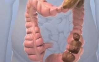 Запор хронический: причины и лечение