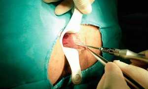 Склеротерапия узлов при геморрое: эффективный метод лечения