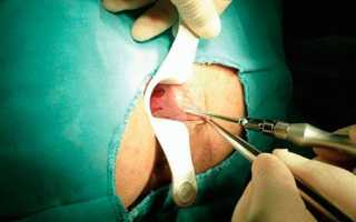 Склеротерапия узлов при геморрое: эффективный метод лечения