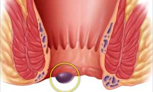 Можно ли греть геморроидальные узлы для облегчения симптомов