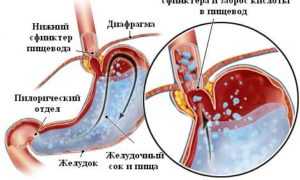 Что такое поверхностный гастродуоденит и его особенности