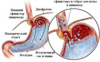 Что такое поверхностный гастродуоденит и его особенности