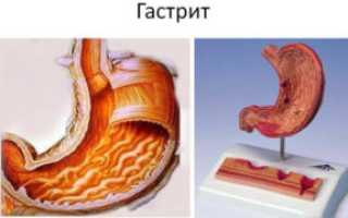 Причины отрыжки воздухом и их последствия