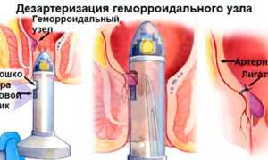 Дезартеризация узлов при геморрое: эффективный метод лечения