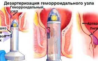 Дезартеризация узлов при геморрое: эффективный метод лечения