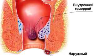 Повышение температуры на фоне геморроя: причины и последствия