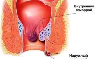 Повышение температуры на фоне геморроя: причины и последствия