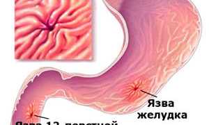 Осложнения при язве желудка и 12-перстной кишки: причины и последствия