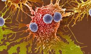 Малигнизация желудочной язвы: причины и последствия