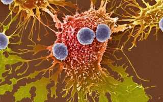 Малигнизация желудочной язвы: причины и последствия