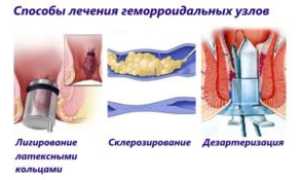 Оперативное удаление геморроя: эффективные методы и рекомендации