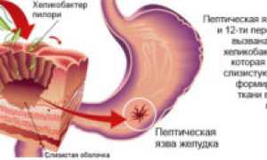 Хеликобактер пилори у детей: симптомы и лечение