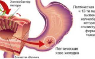 Хеликобактер пилори у детей: симптомы и лечение