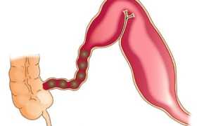 Симптомы кишечной непроходимости: что нужно знать