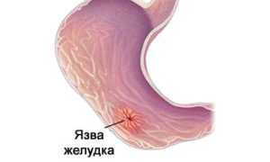 Отрыжка воздухом и одновременно боль в груди: причины и лечение