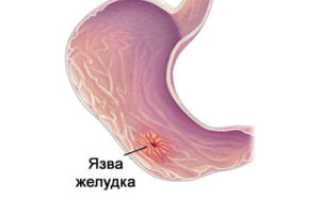 Отрыжка воздухом и одновременно боль в груди: причины и лечение