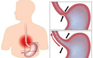 Симптомы рефлюкс-эзофагита и лечение: важные аспекты здоровья