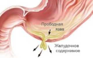 Лечение язвы и гастрита препаратами: советы и рекомендации