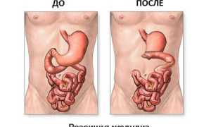 Операция при язве желудка: важные аспекты и рекомендации