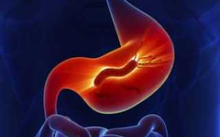 Как диагностируется хеликобактер пилори у пациентов