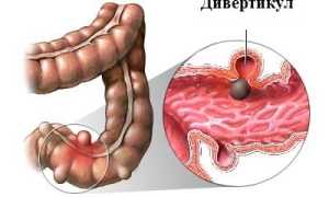 Симптомы появления каловых камней в кишечнике: важные аспекты здоровья