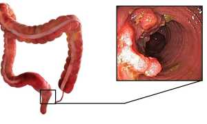 Что делать при запорах после колоноскопии: полезные советы и рекомендации