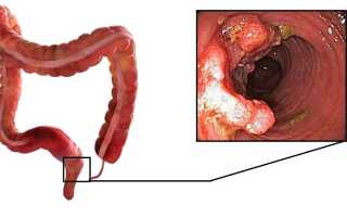 Что делать при запорах после колоноскопии: полезные советы и рекомендации
