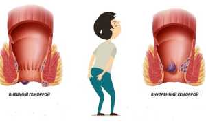 Симптомы внутреннего геморроя у женщин: важные аспекты здоровья