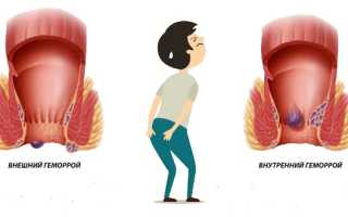 Симптомы внутреннего геморроя у женщин: важные аспекты здоровья