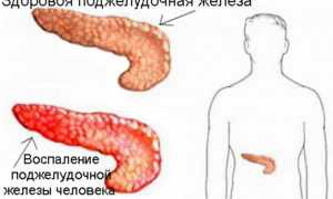 Диета при панкреатите и язве 12-перстной кишки: рекомендации и советы