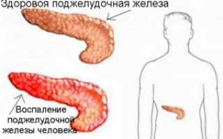 Диета при панкреатите и язве 12-перстной кишки: рекомендации и советы