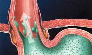 Отрыжка с запахом тухлых яиц: причины и лечение