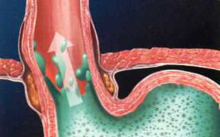 Отрыжка с запахом тухлых яиц: причины и лечение