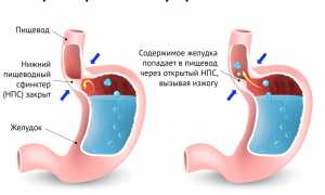 Изжога и боли в желудке: причины и лечение