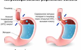 Изжога и боли в желудке: причины и лечение