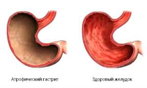 Атрофический очаговый гастрит: причины и лечение