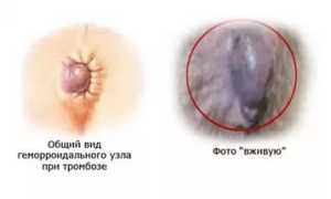 Тромбоз геморроидальный: причины и лечение