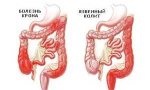 Что такое диарея и как с ней справиться