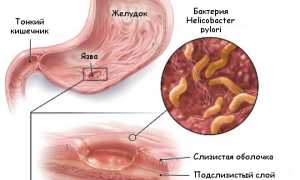 Сколько лежат в стационаре с язвой желудка: важные аспекты лечения