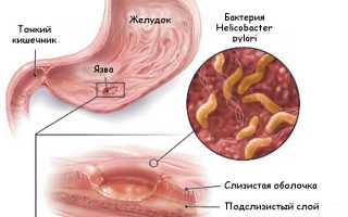 Сколько лежат в стационаре с язвой желудка: важные аспекты лечения